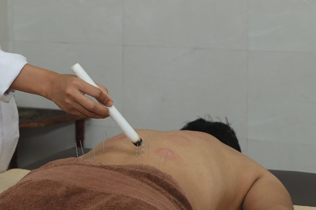Acupuncture with moxibustion